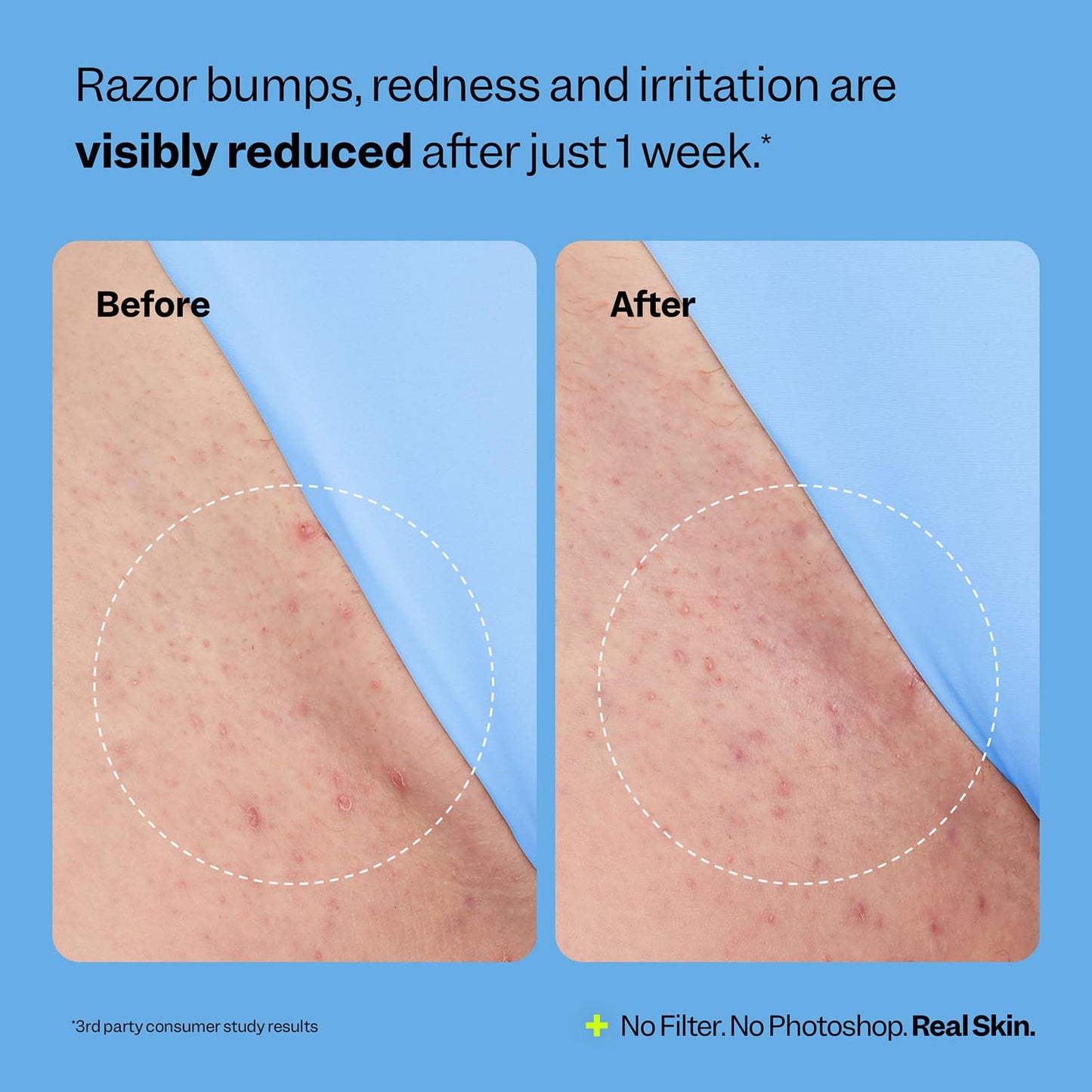 Ingrown Hair Smoothing Solution